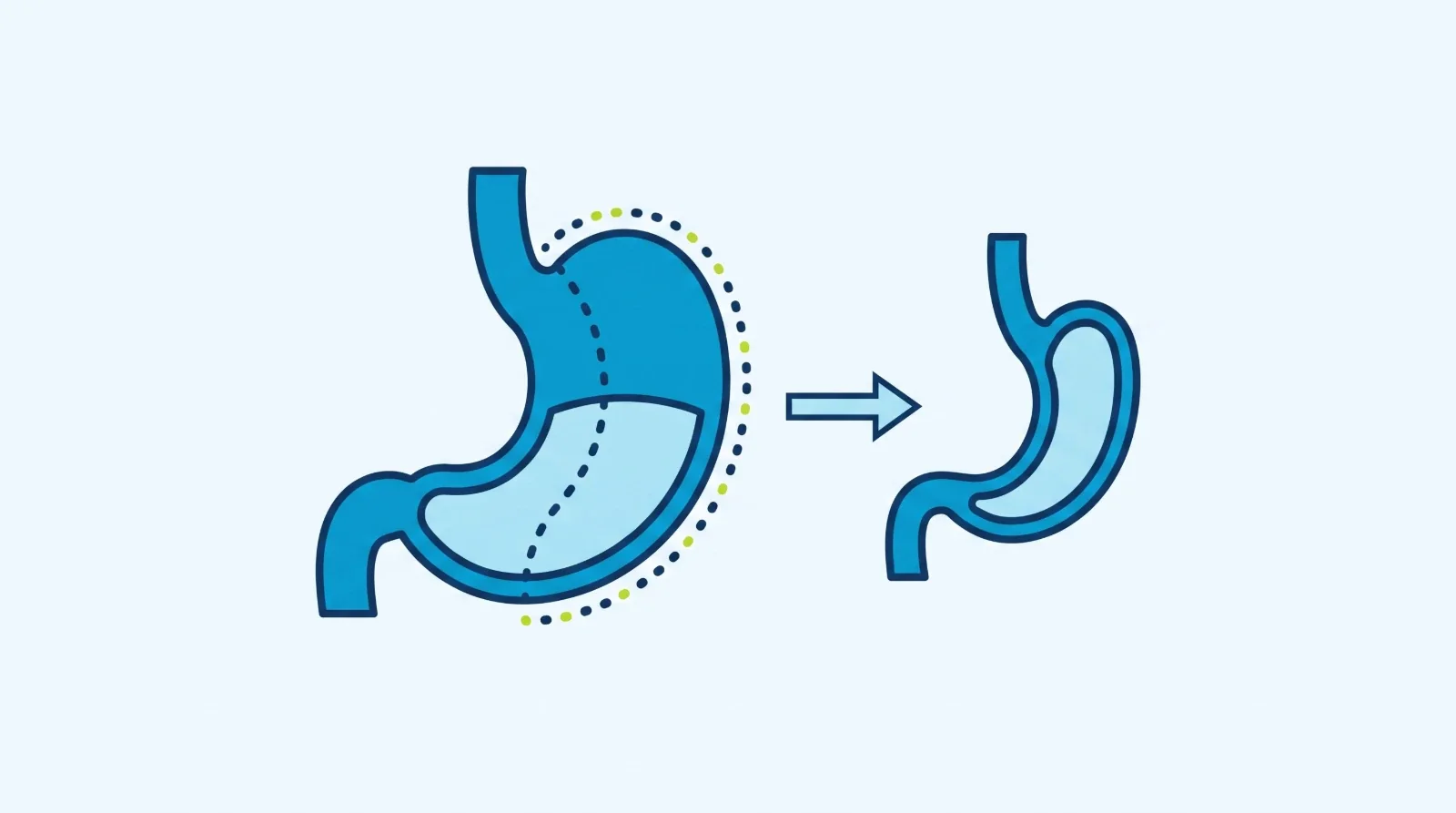 Diagram: a stomach with a dotted line along its outer curve, and an arrow to the narrow sleeve shaped stomach left after the operation